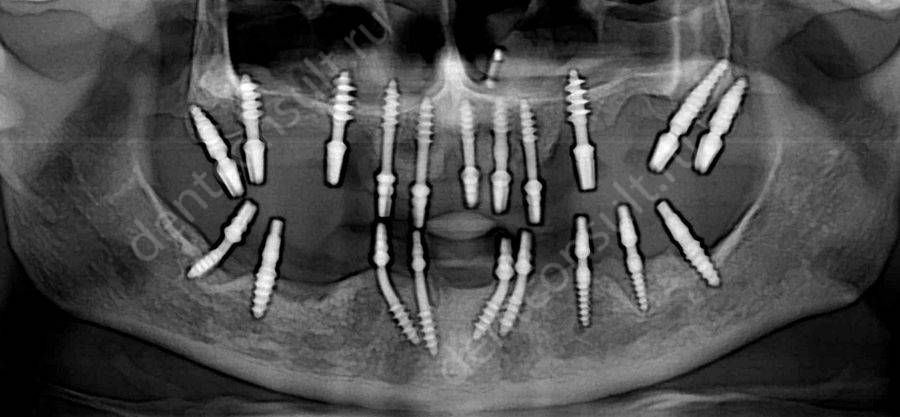 Установленные базальные импланты для восстановления всех зубов
