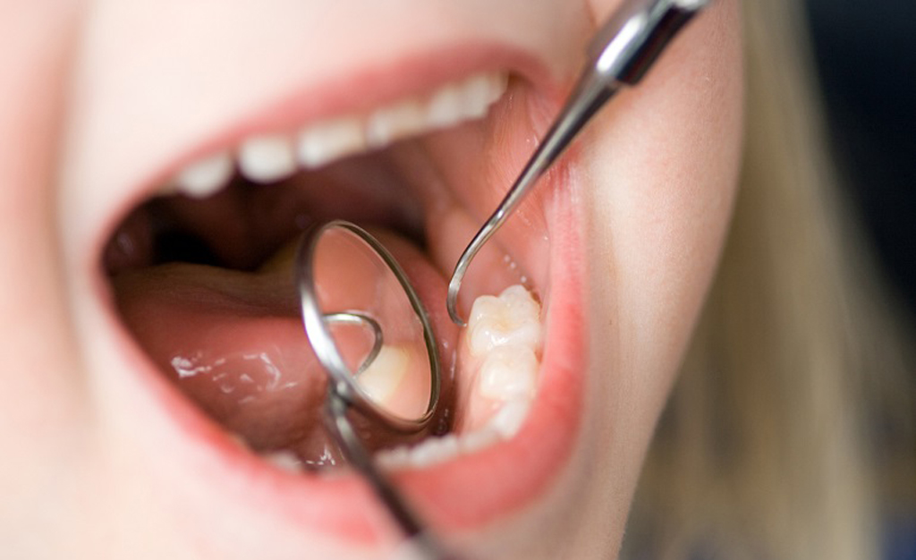 Почему же возникает кариес молочных зубов?