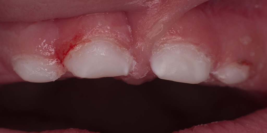 Болезнь может проявится на первых зубах
