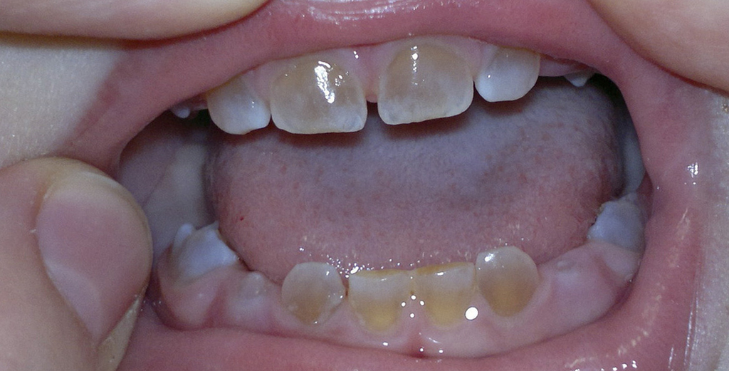На фото показаны тетрациклиновые зубы у ребенка