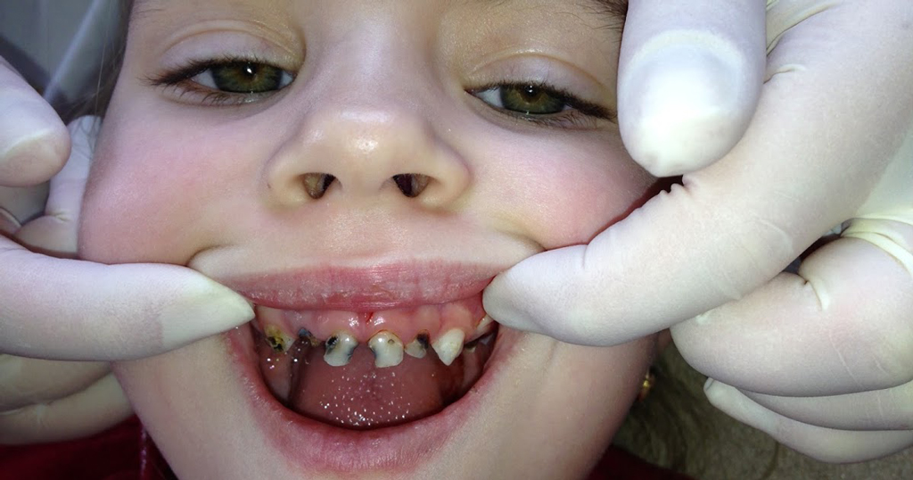 Черные зубы выглядят довольно не эстетично и могут привести к комплексам у ребенка