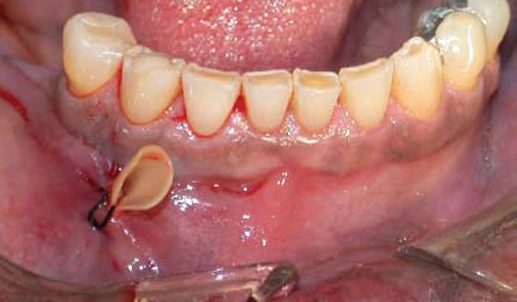 Дренаж в стоматологии