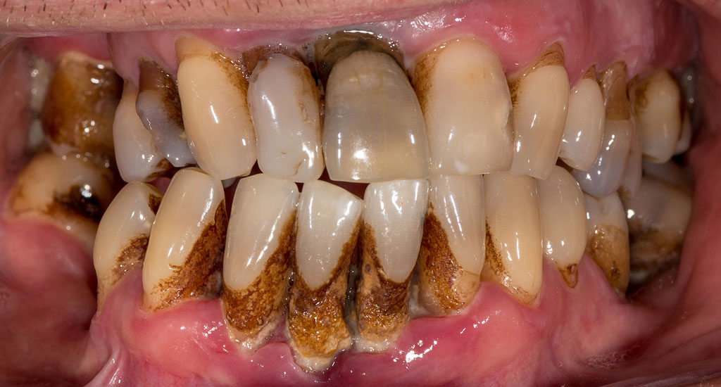 Причины, из-за которых может болеть зуб
