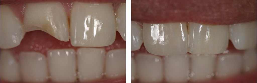 На фото показан зуб до и после установки световой пломбы