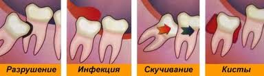 Процесс воспаления десны рядом с зубом мудрости