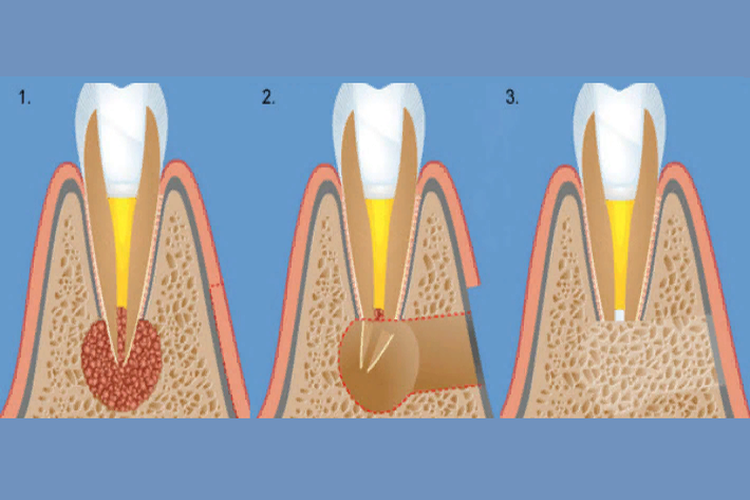 гранулема на зубе