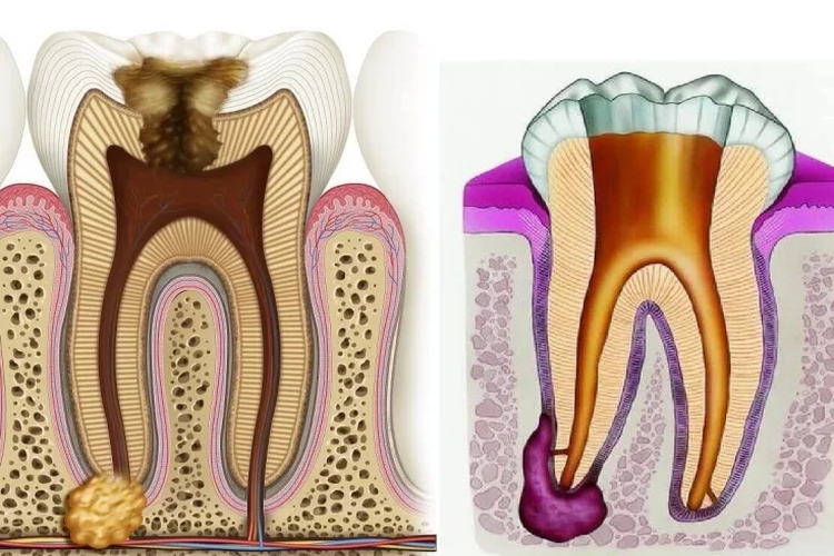 лечение гранулемы зуба