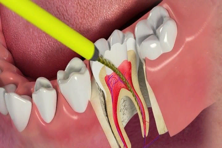 почему болит зуб без нервов