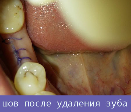 шов после удаления зуба