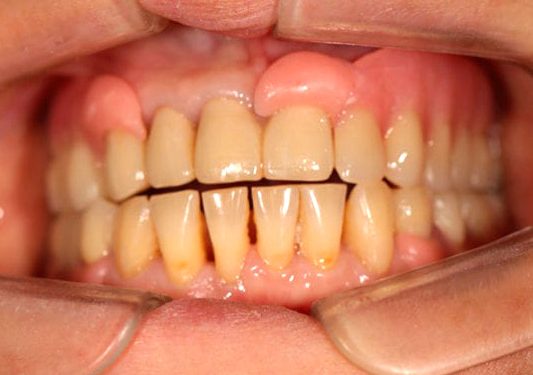 зубные протезы натирают десны