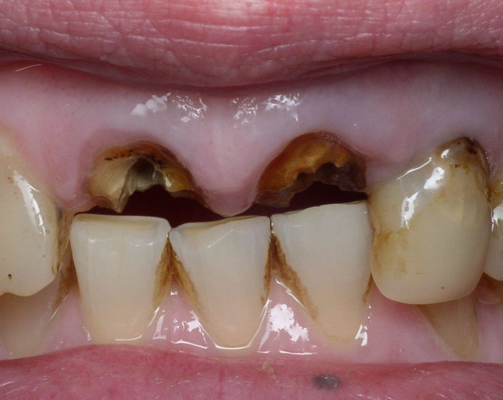 Фото разрушения зубной коронки