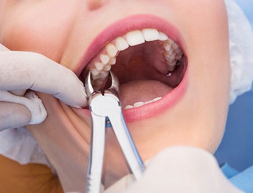 процедура удаления зуба
