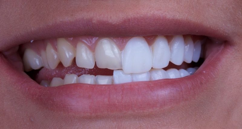 коронопластика зубов