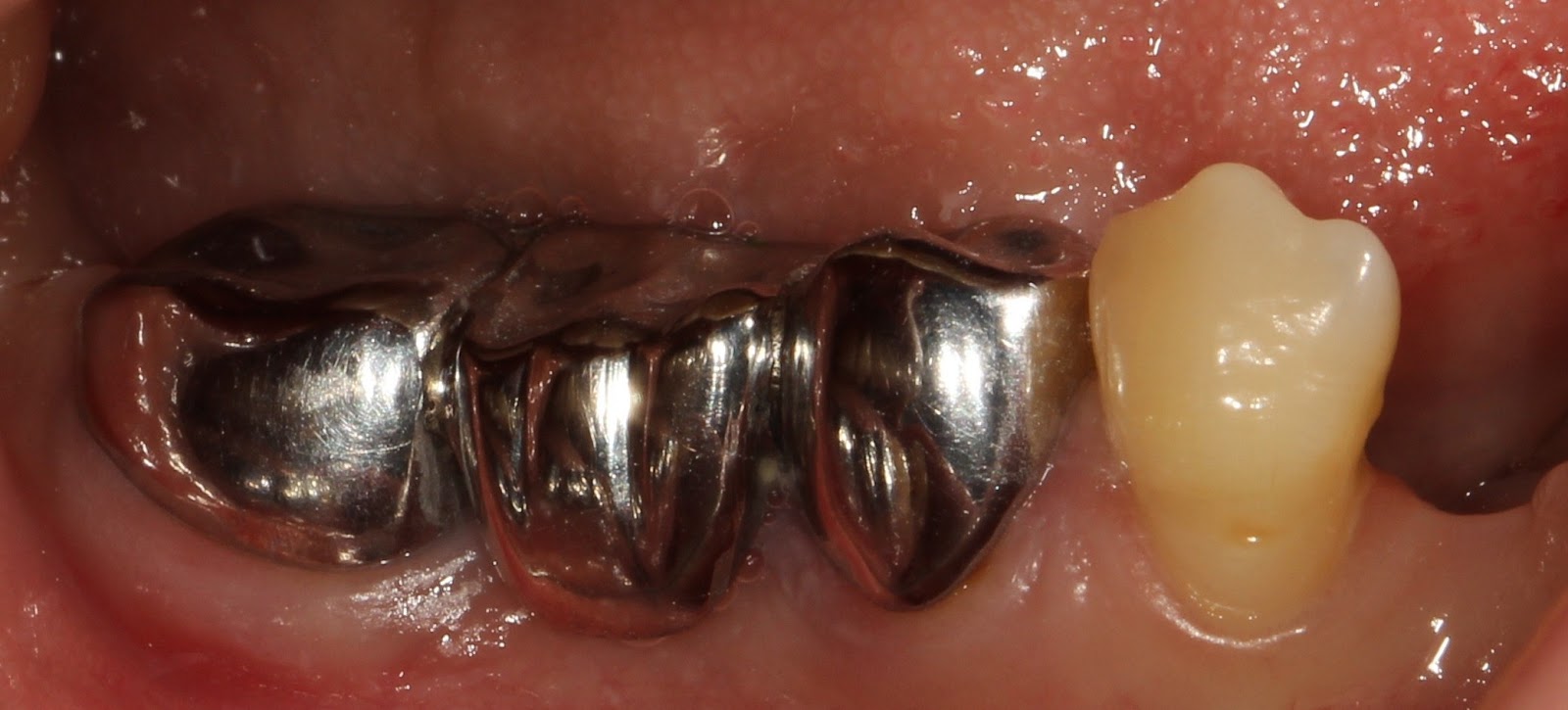 Фото: металлокерамические зубы выглядят эстетичнее, чем металлические