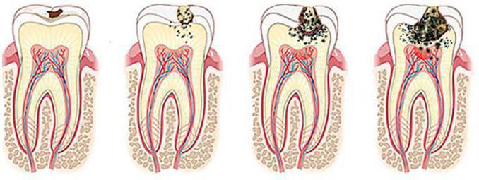 Классификация кариеса зубов