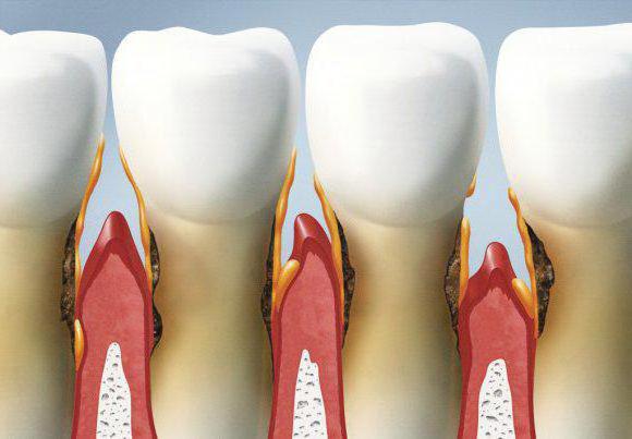 кровоточат десна во время чистки зубов