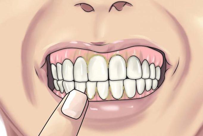кровоточат десны при чистке зубов лечение