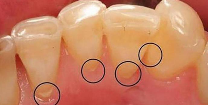 почему появляется зубной камень на зубах