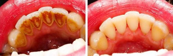 от чего появляется зубной камень причины оброзования