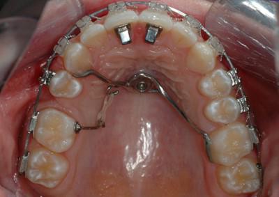 зубы верхней челюсти