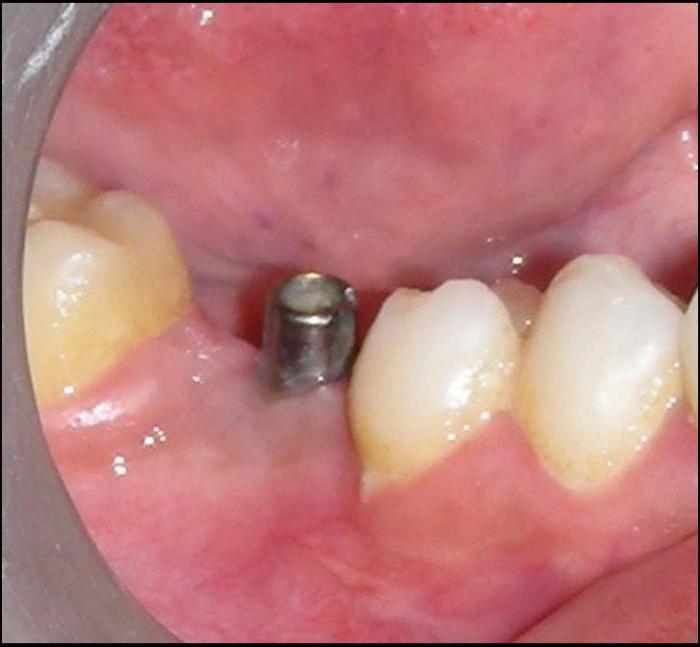 метод базальной имплантации зубов