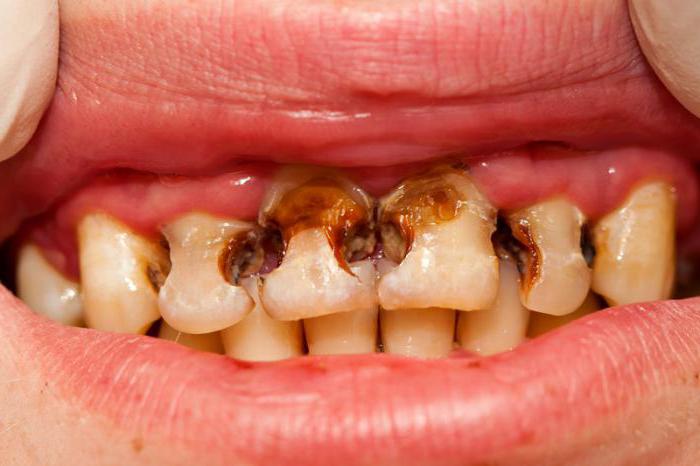 процесс разрушения зубов