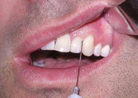 плазмолифтинг в стоматологии отзывы врачей