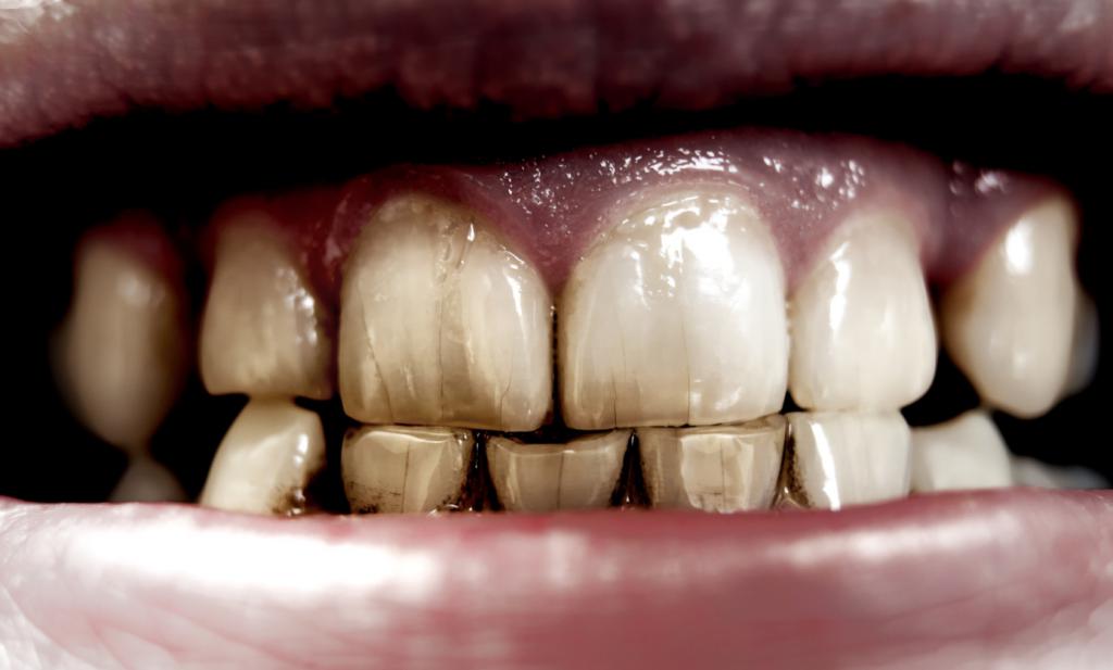 Прозрачные зубы с темными полосками