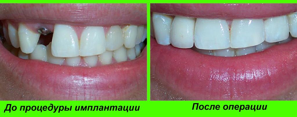 Импланты передних зубов фото до и после