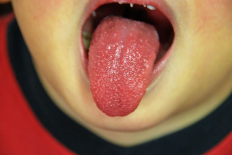 язык с красными пятнами у ребенка