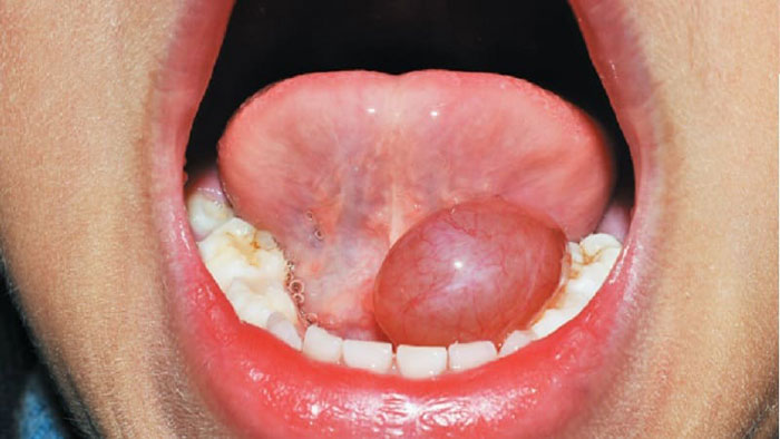 Воспаление под языком
