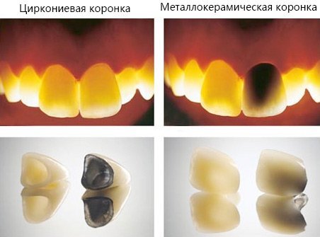 Циркониевые коронки на верхние передние зубы