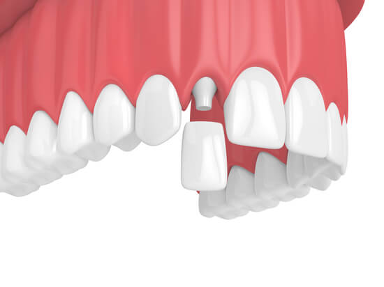 Коронки имакс для передних зубов
