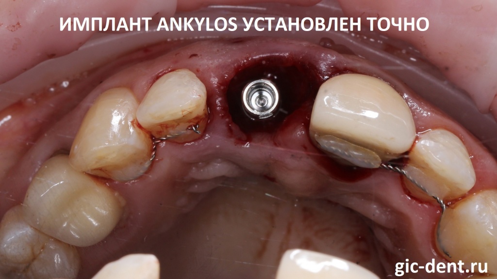 Имплант Ankylos был установлен в идеальной позиции. Операцию проводит хирург-имплантолог Дахкильгов Магомед Уматгиреевич. 