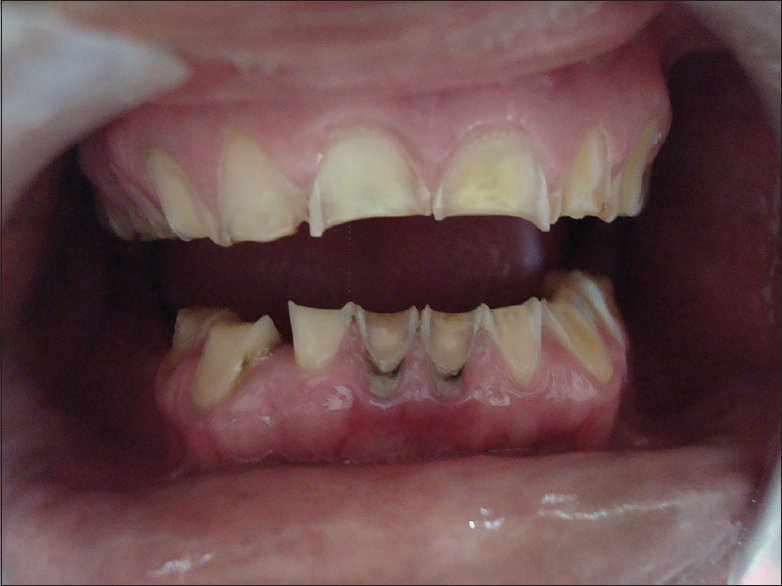 Истирание эмали зубным порошком