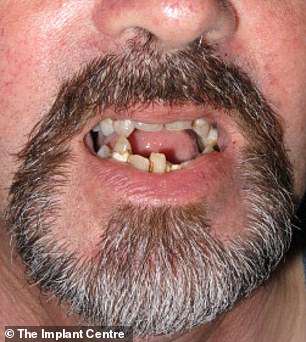 Before: Kevin had a bad experience with the dentist as a child and avoided going back for several decades
