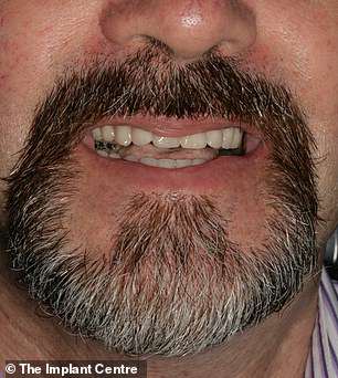 After: Kevin had infected teeth removed under sedation and implants inserted to replace them