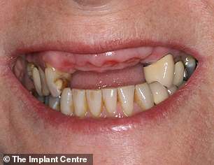 Diane had to wear dentures after losing five of her top teeth when she was injured in a car accident