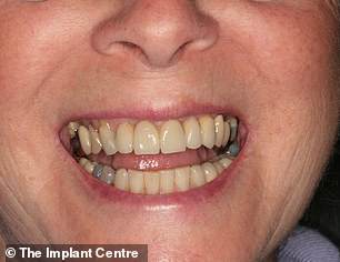 Now she no longer has to wear dentures and has rediscovered her confidence