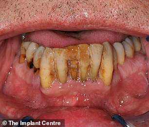 Matt neglected his teeth for more than 20 years and was wearing a denture for his upper teeth