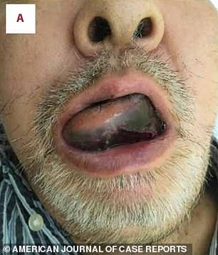 The 71-year-old man was taken to hospital because he was struggling to talk or swallow properly (pictured on day one)