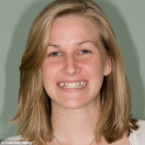 Emily Cheeseman was very self-conscious about her smile before she had adult teeth implants