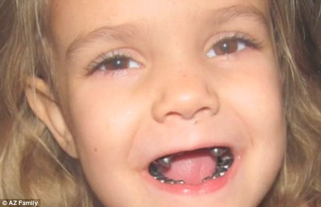 Metal mouth: Savannah White, four, had every single one of her teeth crowned with silver when her mother took her to a dentist in Arizona for a routine procedure