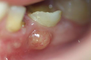 abscess tooth