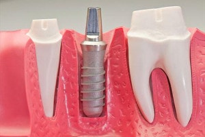 dental implant schematic