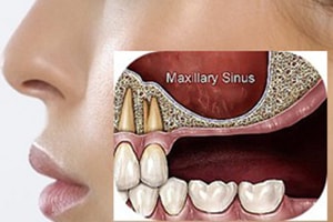 dental implants temporary contraindication : maxillary sinus lowering