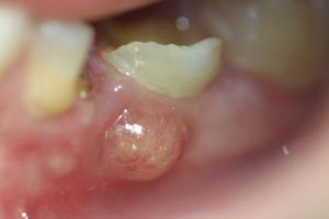 acute apical periodontitis : dental abscess