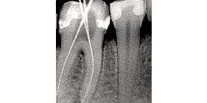 dental X ray periapical view