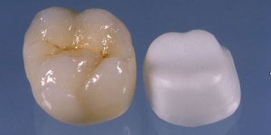 porcelain crown with zirconia substructure