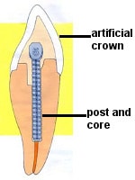 post and core schematic